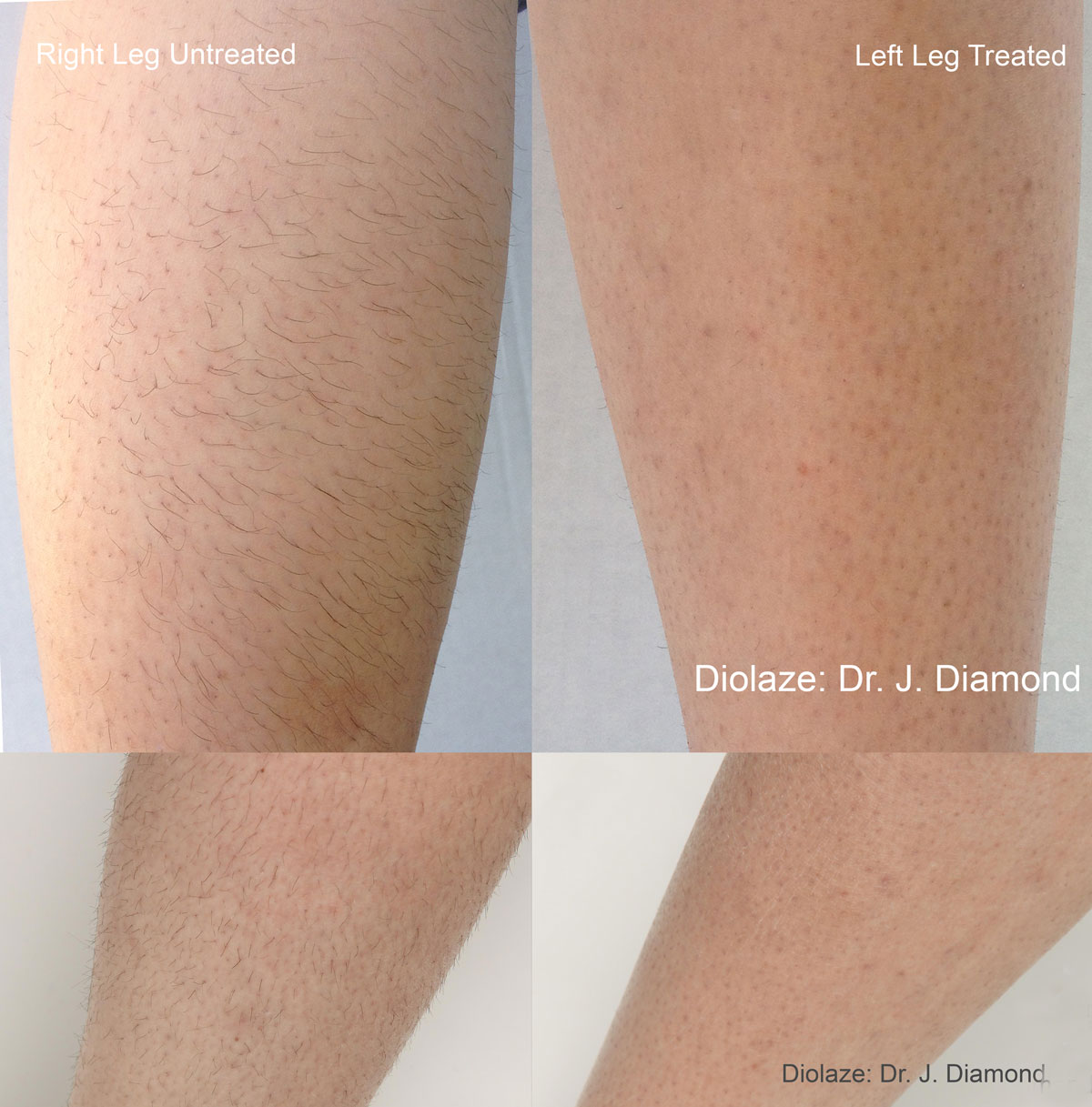 Hair Removal Health Horizons USA