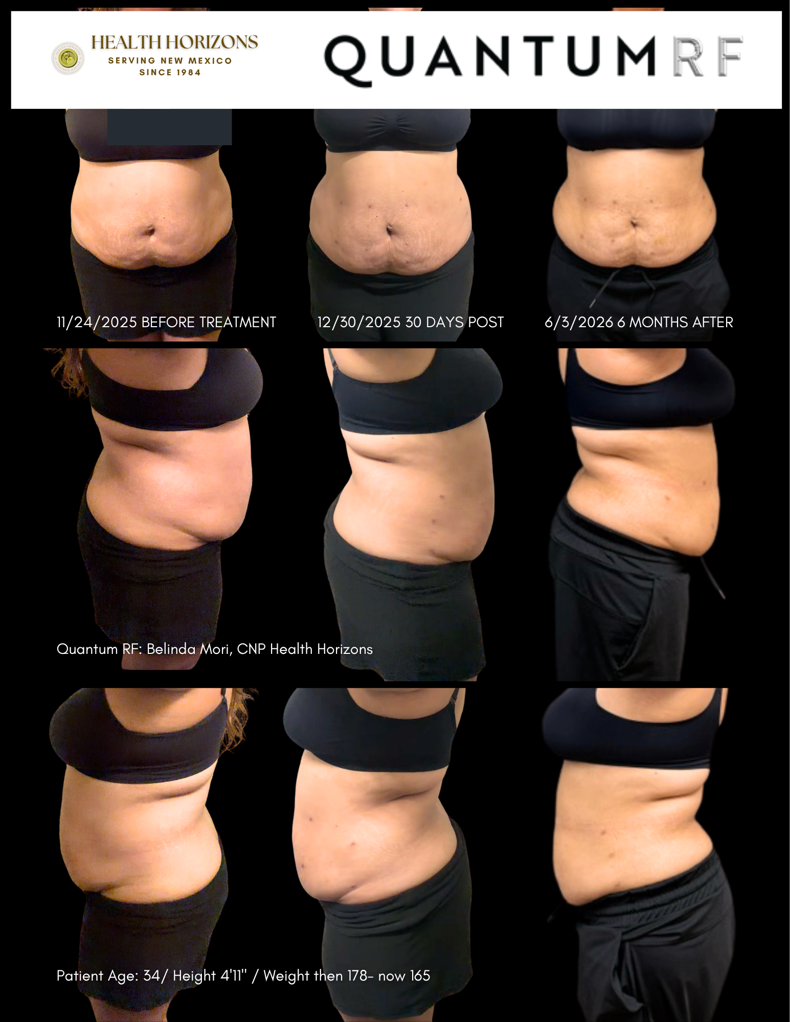 AnnMarie Duran Quantum RF Before and After photos 06032026 (2)