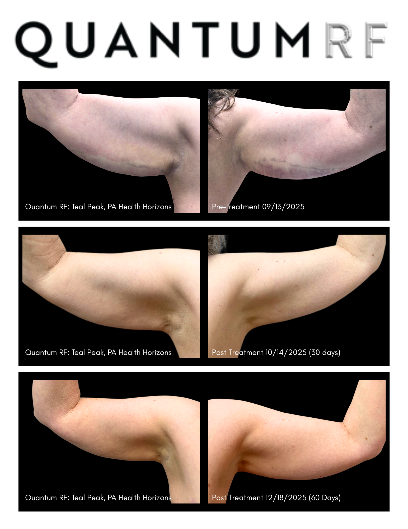 Cami Moses Quantum RF Progress Photos -Pre_30_60 days Post