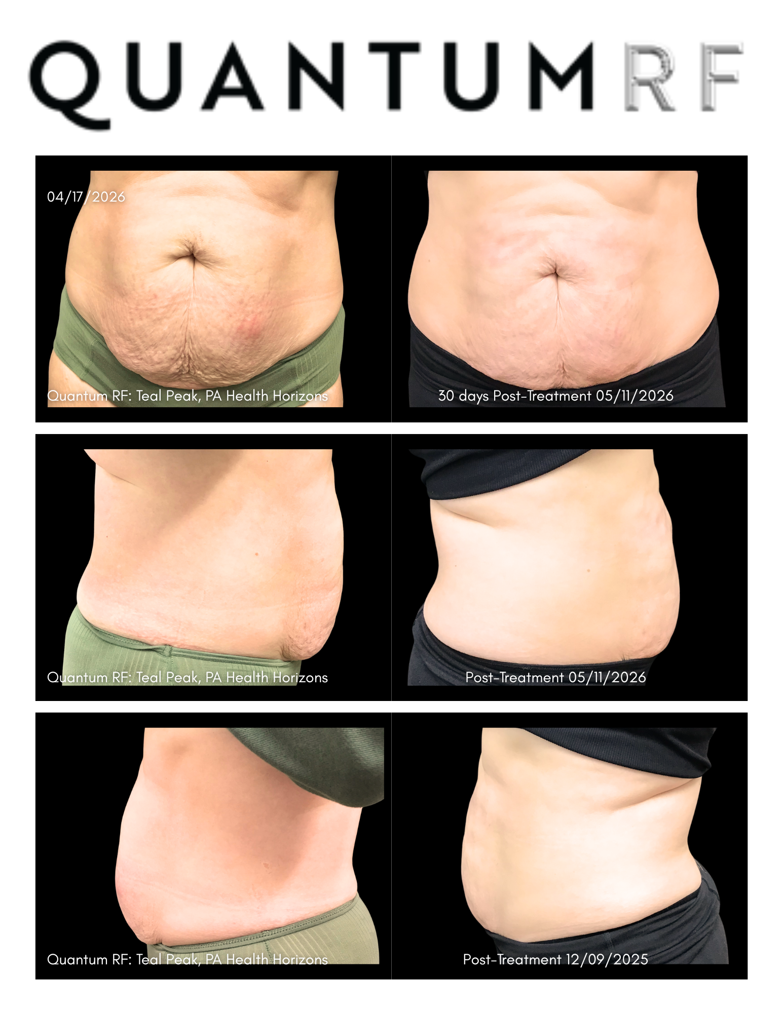 Nicole Gatewood Quantum Pre & Post 30 days