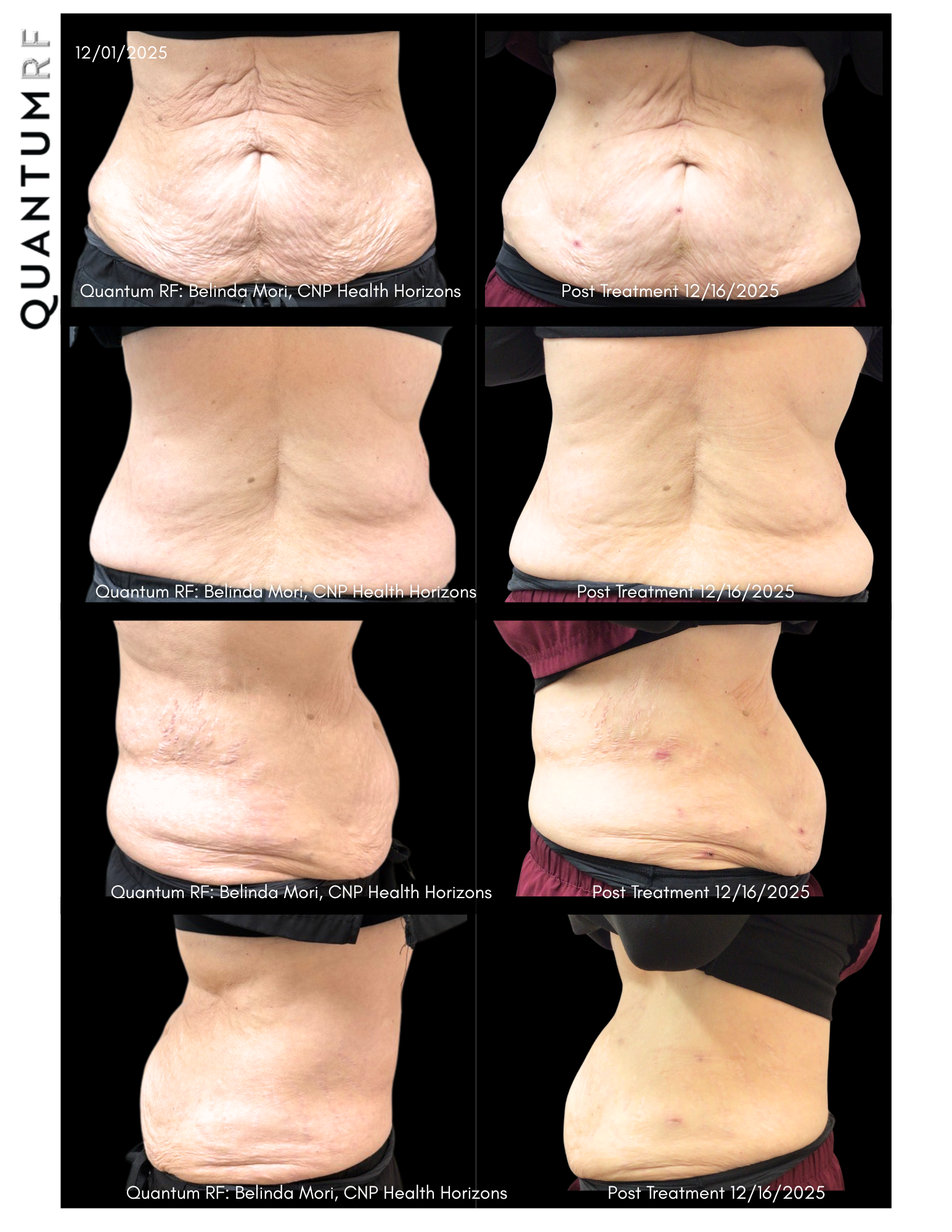 Ronda Wolfe Quantum Pre & Post 15 days