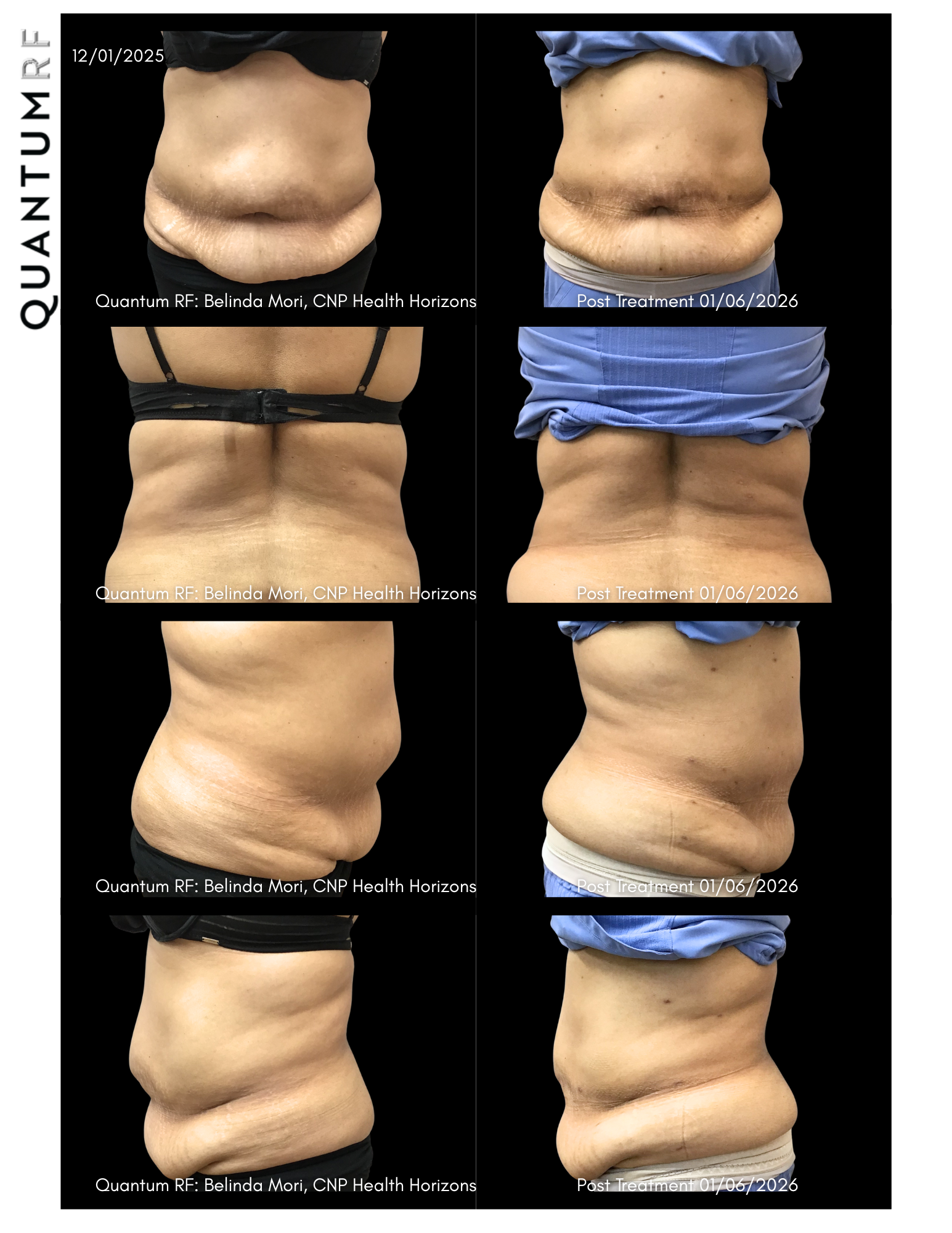 Susanna Cisco Quantum Pre & Post 30 days